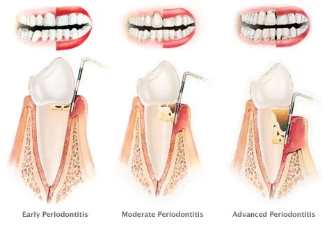Fasi parodontite