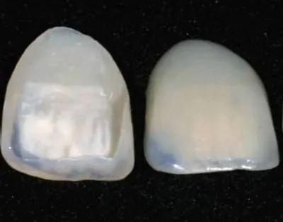 faccette dentali