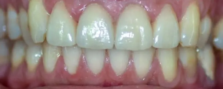 Faccette dentali dopo
