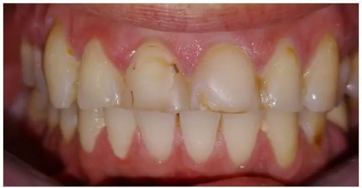 faccette dentali prima