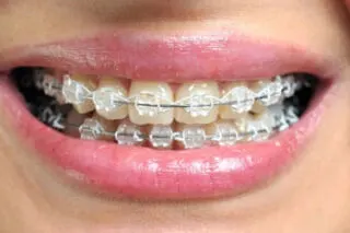 apparecchio fisso con attacchi estetici in ceramica