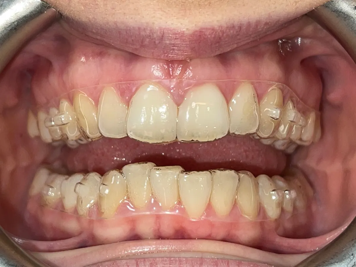 APPARECCHIO INVISIBILE E APPARECCHIO INVISALIGN: SONO DA PREFERIRE ALL’APPARECCHIO FISSO?