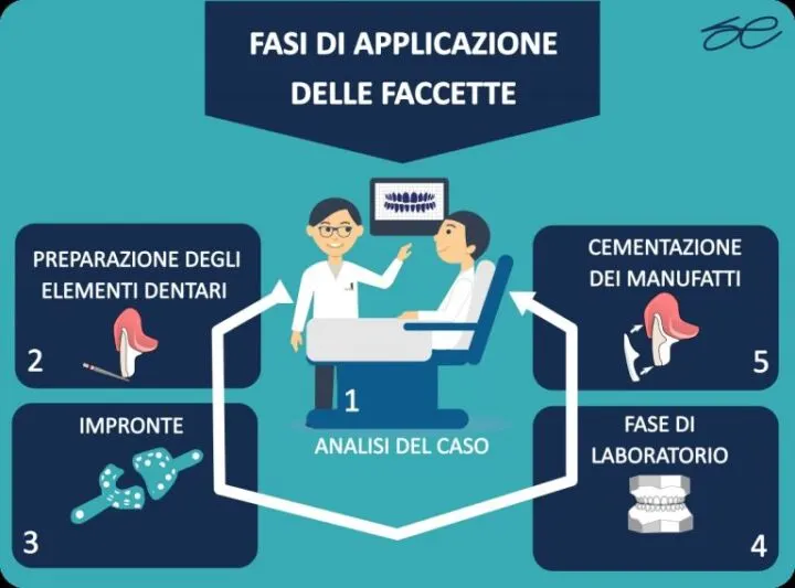 TECNICA DI APPLICAZIONE DELLE FACCETTE DENTALI