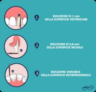 Come funziona il trattamento delle faccette