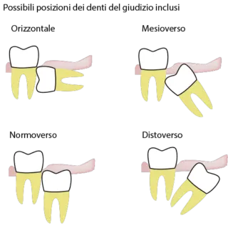 posizioni denti del giudizio