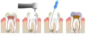 devitalizzazione dentale