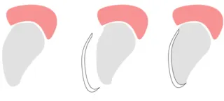 Applicazione faccette dentali