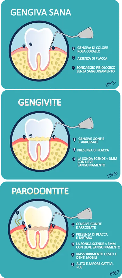 i tre stadi della parodontite