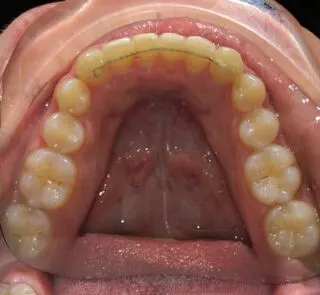 Contenzione fissa inferiore di fine trattamento in paziente che partiva da elevato affollamento