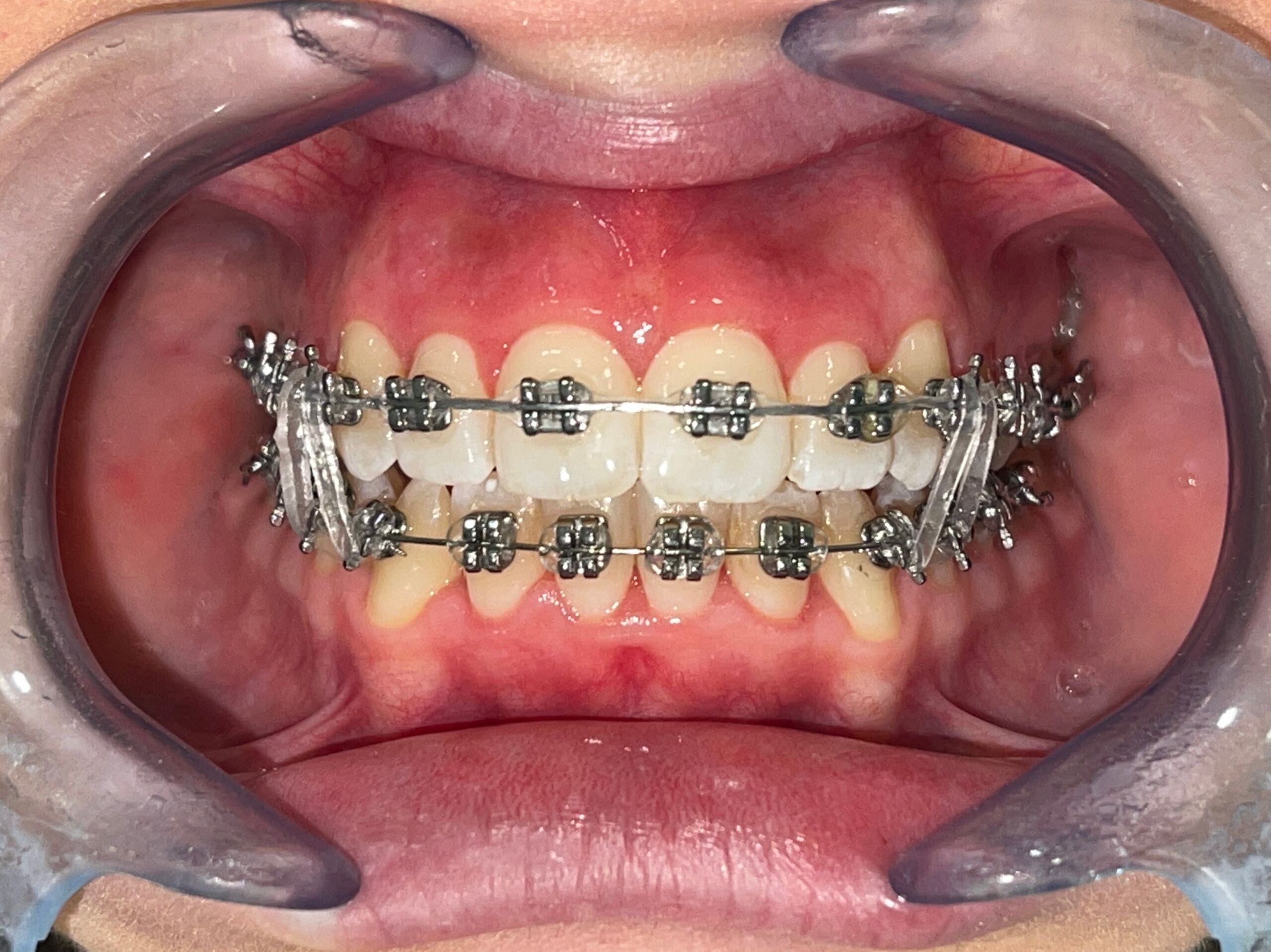 L'apparecchio fisso ortodontico: a cosa serve?